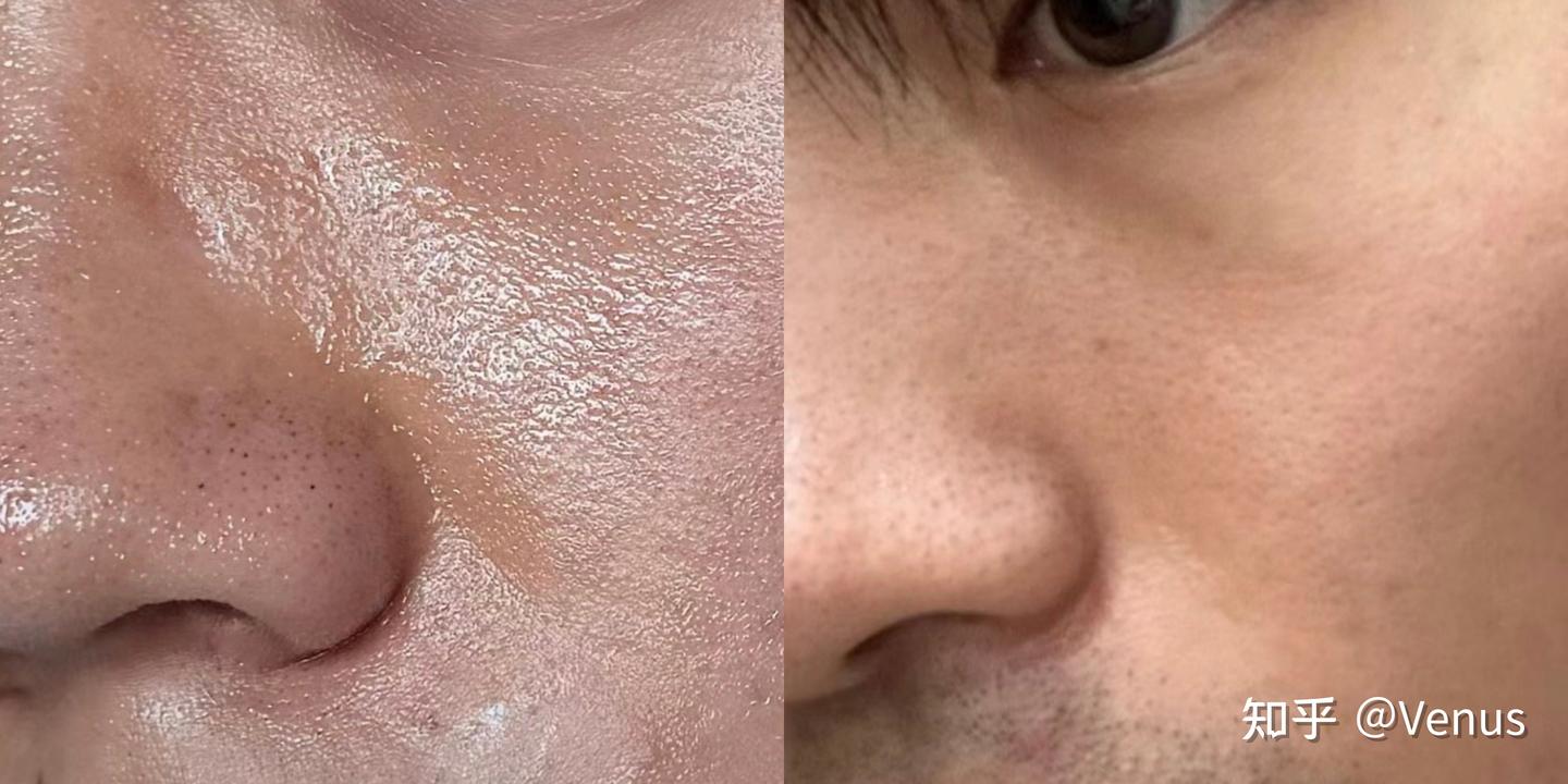 男生脸上出油长痘显的很脏有啥解决办法没?