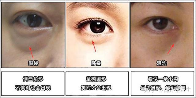 卧蚕是宝,眼袋是草!