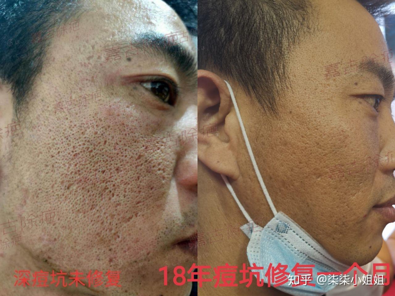 针对痘坑修复的效果大家自己看图衡量吧