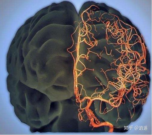 关于烟雾病moyamoyadisease01前言