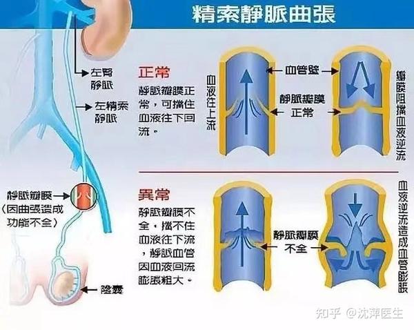 精索静脉曲张一直疼怎么办,症状与预防 - 知乎