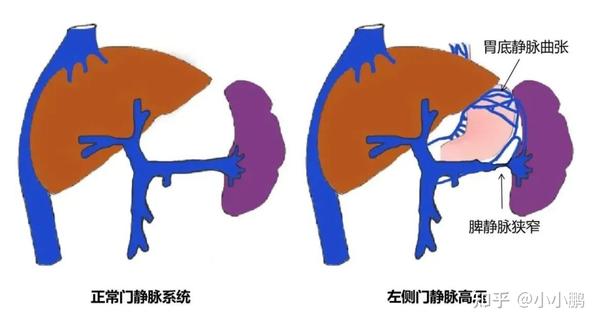 门静脉高压 AND TIPS - 知乎