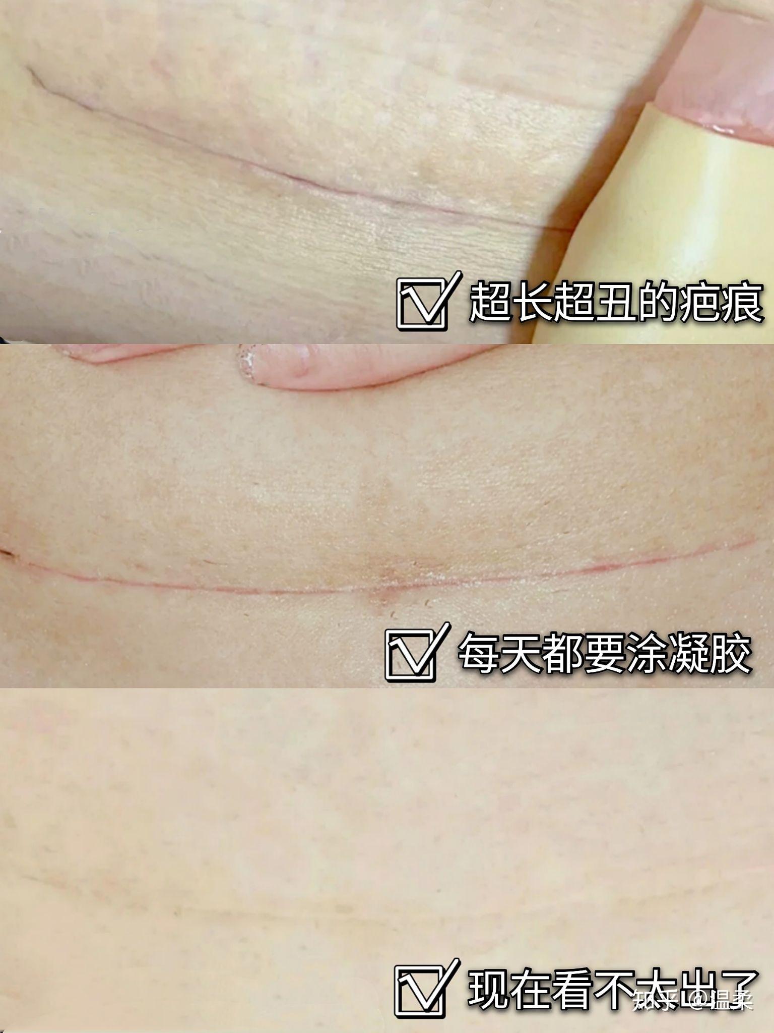 麻麻都想知道剖腹产疤痕怎么可以去除掉我来解答一下