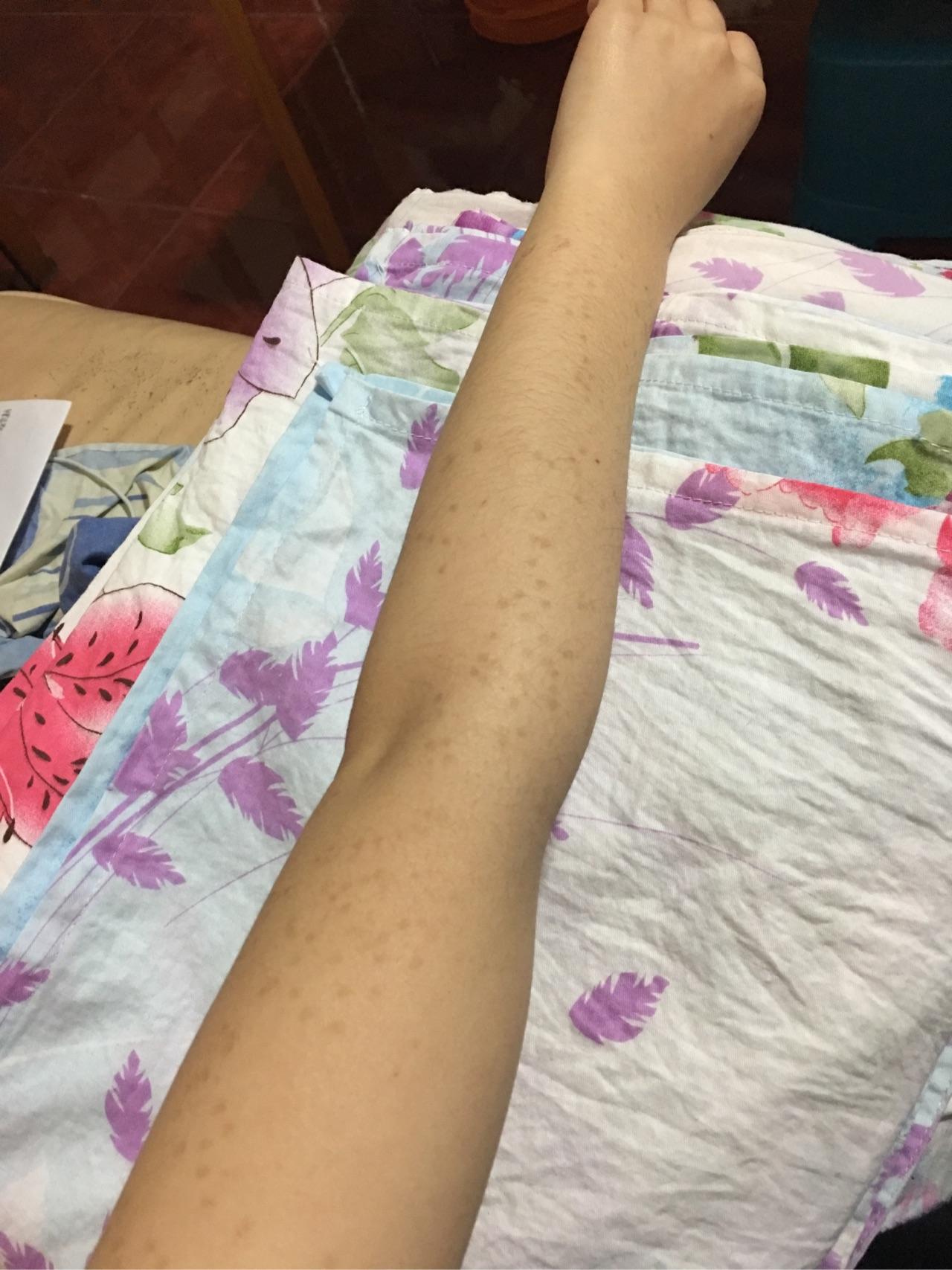 去年12月激光祛除双侧手臂的斑点现在留下色素沉着色素沉着的斑点比没