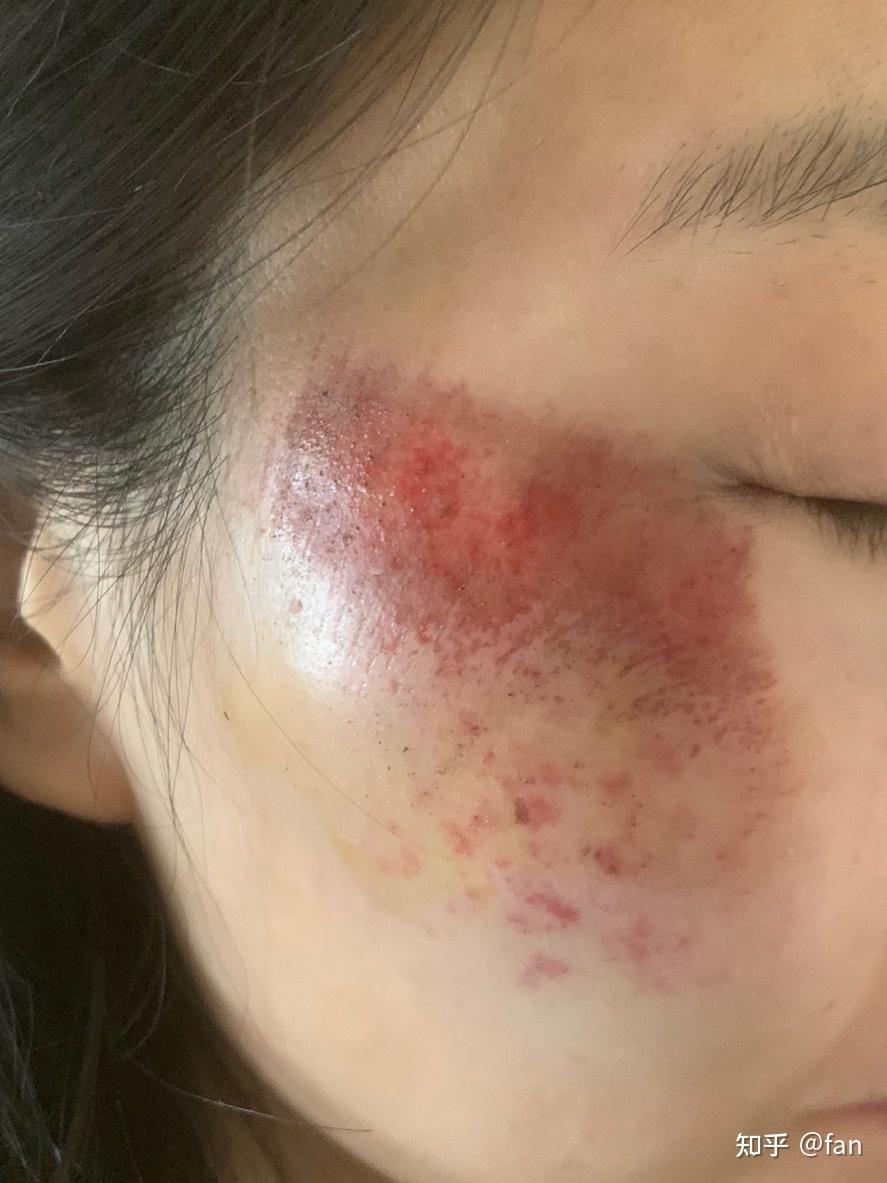 面部摔伤如何不留疤