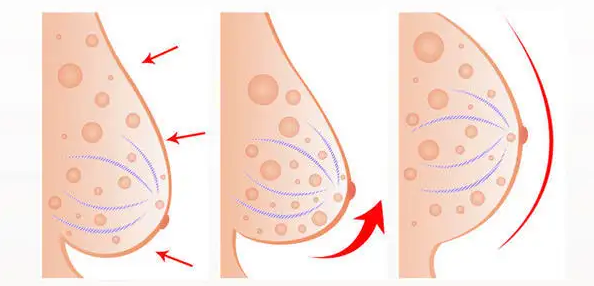 雙環法乳房下垂矯正術,是在乳暈周邊做雙環形切口,切除部分鬆弛的皮膚