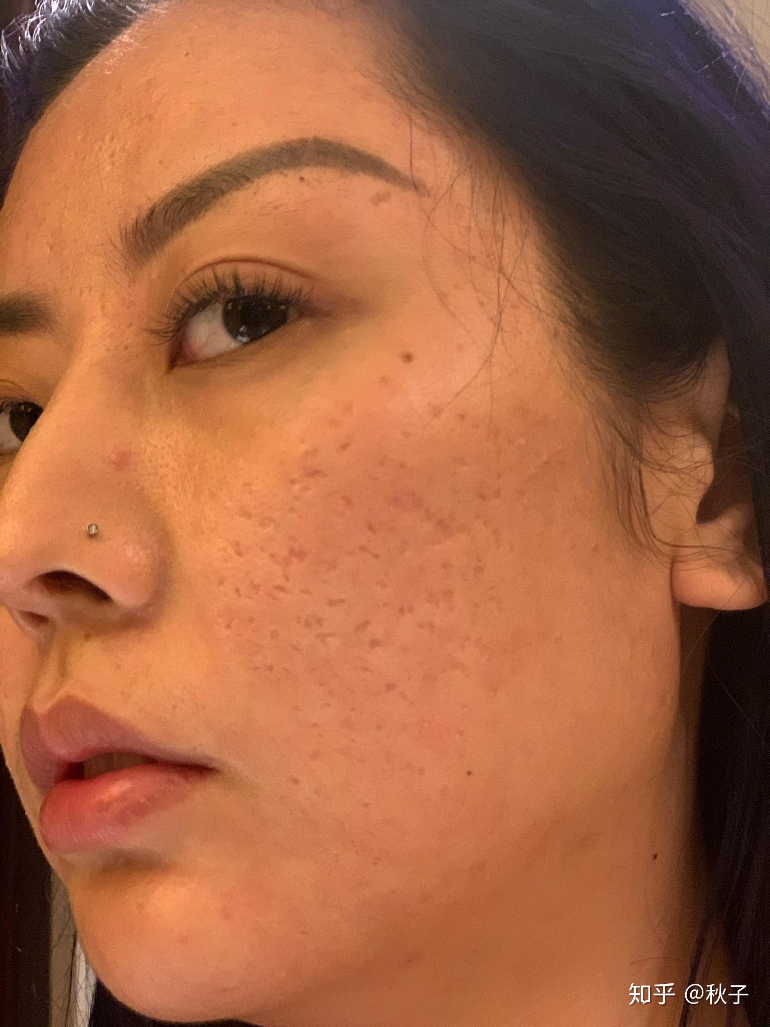 请问我这种是属于什么类型痘坑有比较好的治疗手段吗