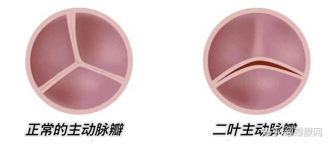 三叶式主动脉瓣图片