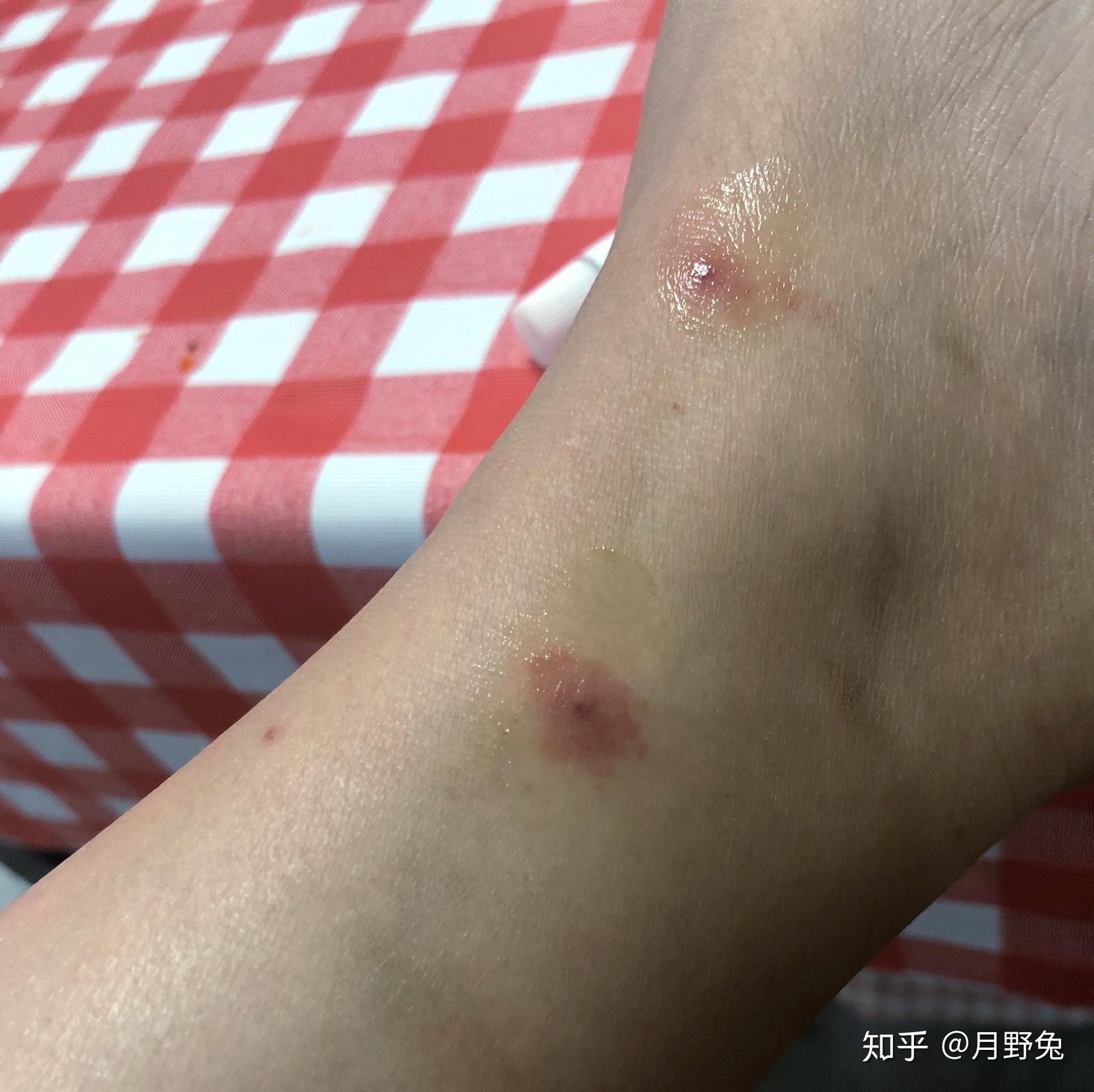 過敏性紫癜性腎炎你有沒有找對醫生