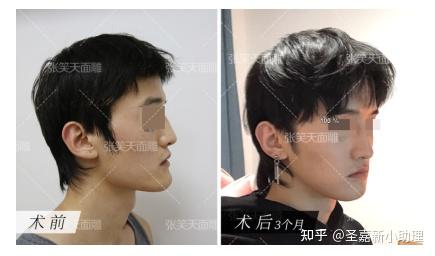 张笑天颏成型手术详解下巴不好看月亮脸后缩太长