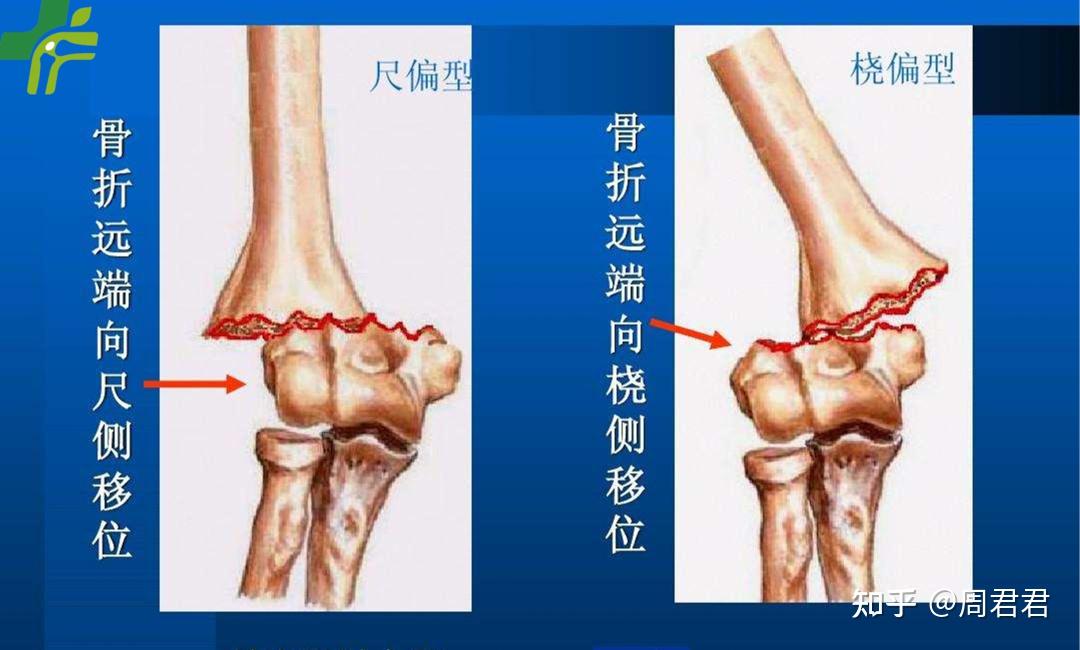 三口骨科品牌故事三口伯伯说骨事肱骨髁上骨折你知多少