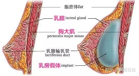 不会,假体安置在胸大肌下方,上面会有乳腺组织跟肌肉组织,所以一般是