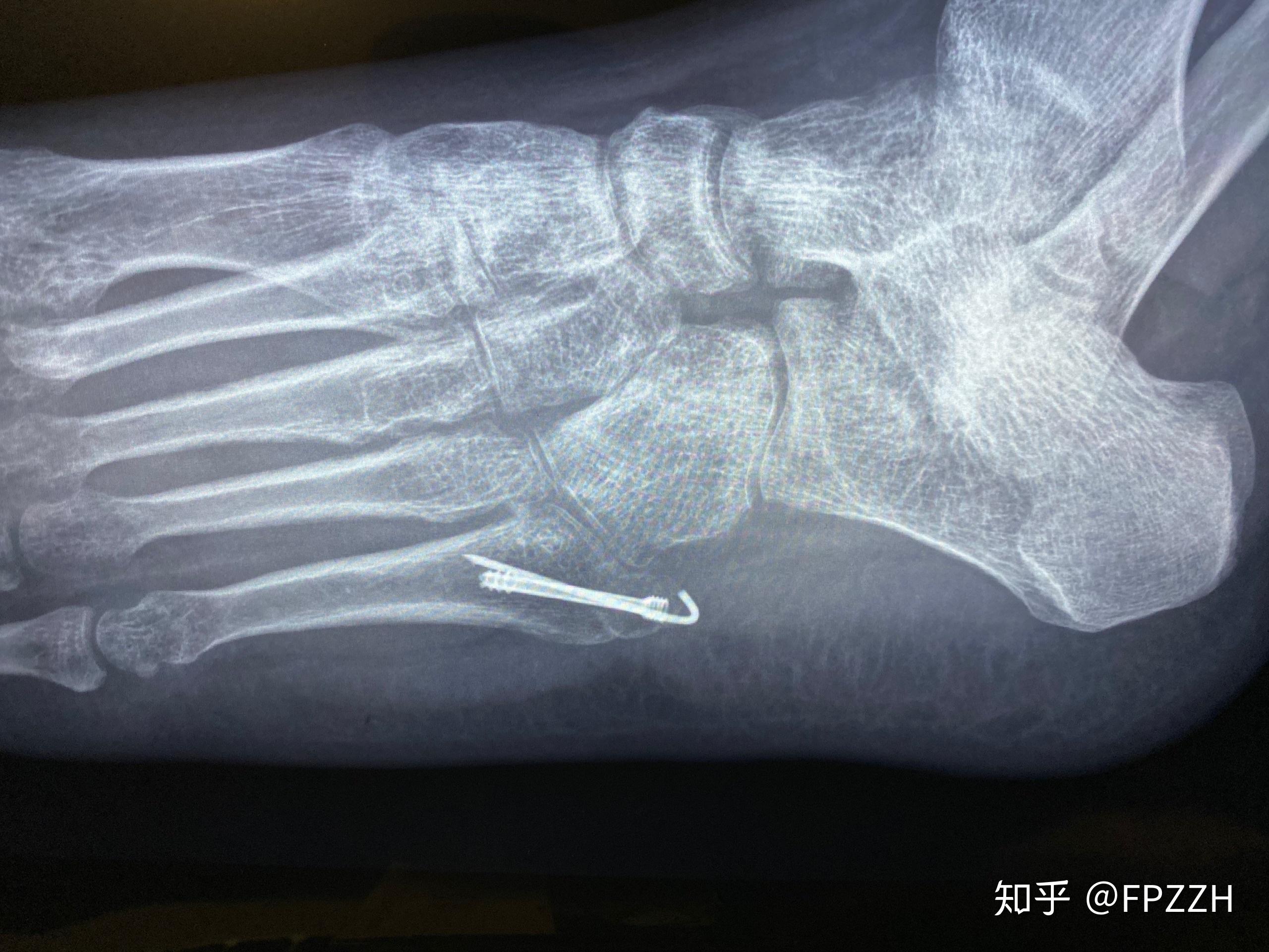 第五跖骨基底部骨折恢复记录