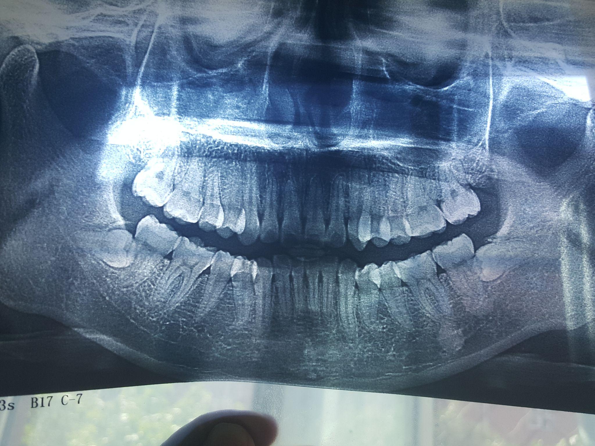 我的牙齿正畸之旅——31岁 - 知乎