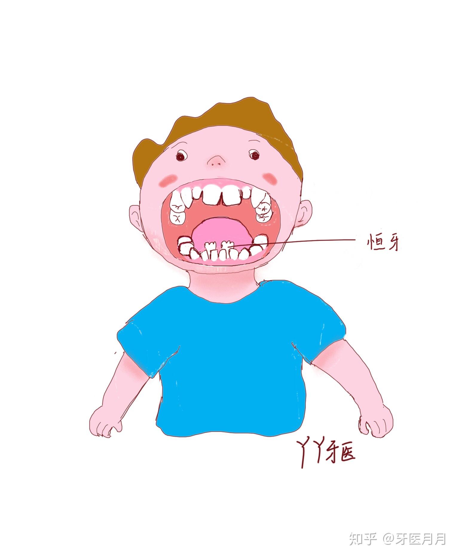 小孩换牙应该注意哪些事