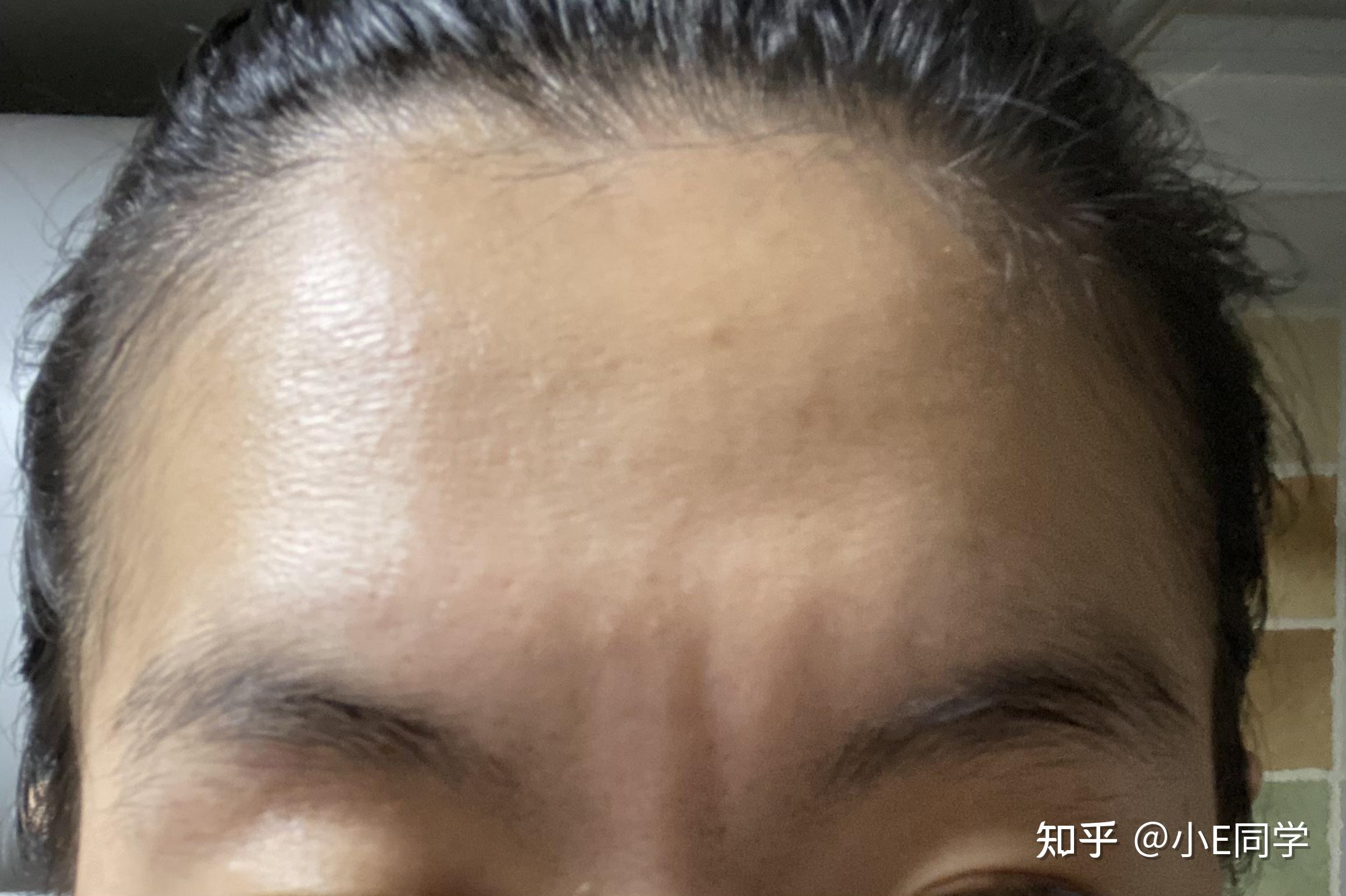 55岁农民首次做医美，分享北京川字纹切除全流程 - 知乎