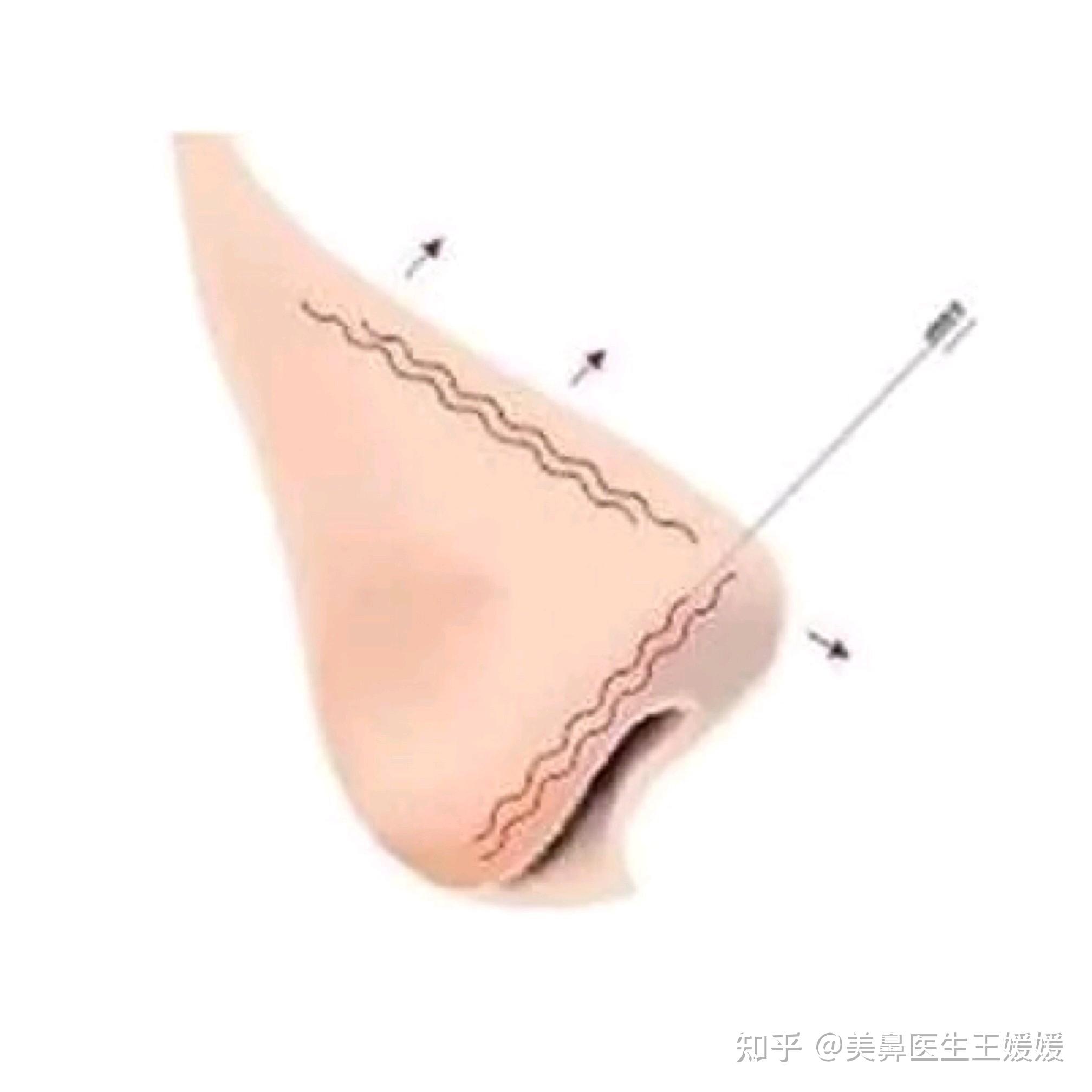 塑形,采用多线平行抬高鼻梁和鼻尖鼻小柱线雕采用的是可吸收蛋白线