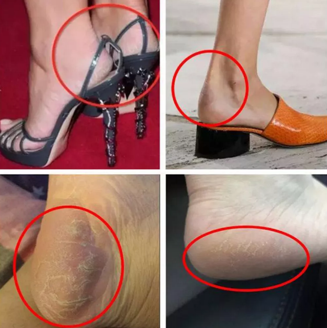 不到百元的美脚神器,轻轻一喷带走老废角质,拯救老奶奶脚