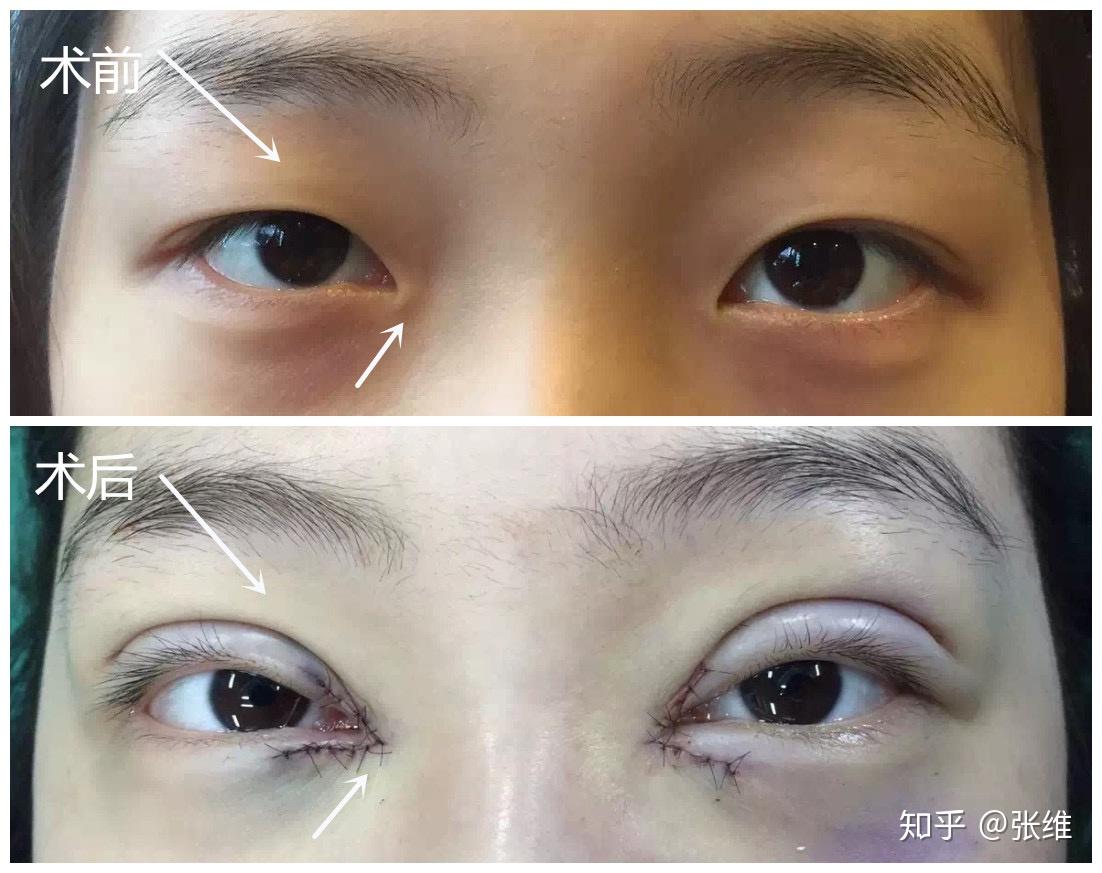 双眼皮开内眼角手术分享18年4月18日持续更新多图 - 知乎