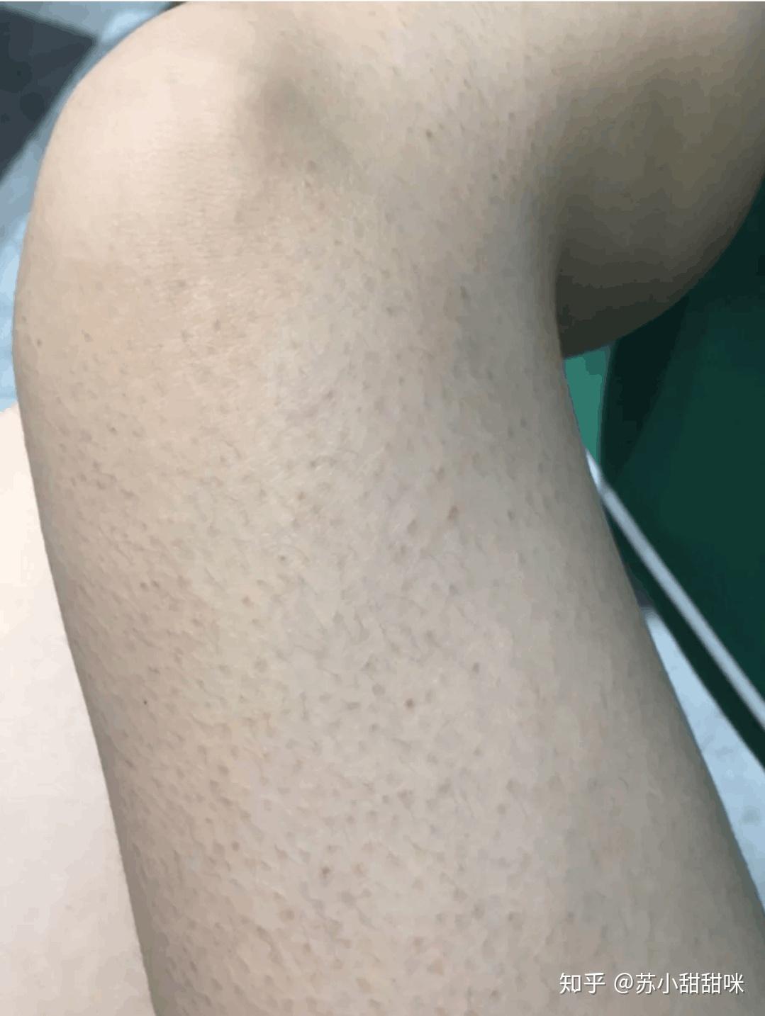 可以推荐几个去鸡皮肤的身体乳吗? - 知乎