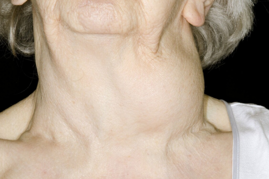 女性甲状腺癌的症状图片