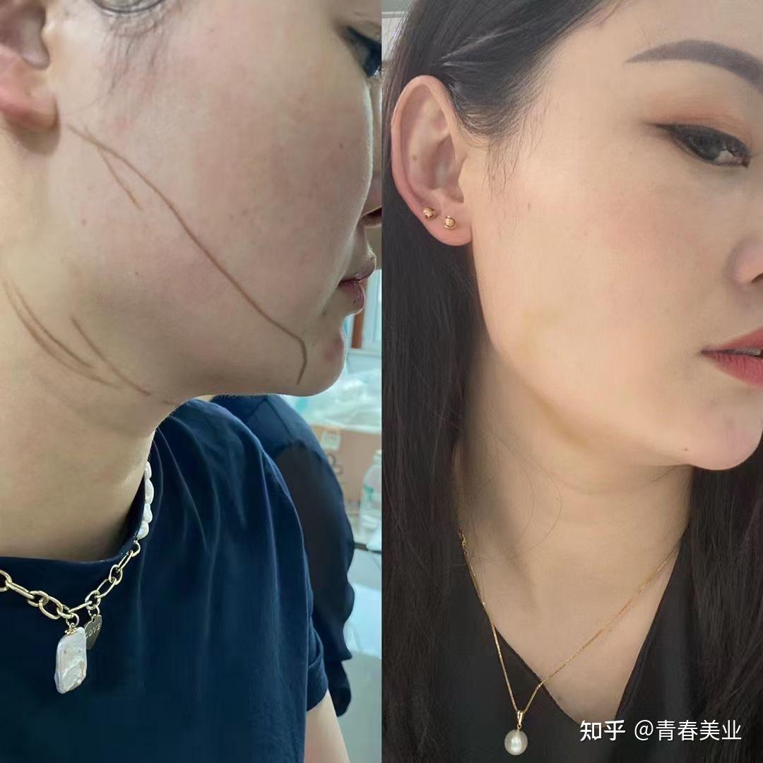 胖和瘦的区别下颌线对比侧脸更立体精致侧颜