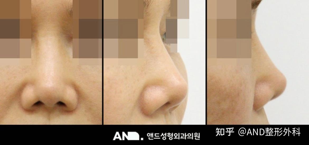 鼻部修复手术Medfore、GORE-TEX导致的鼻梁改善方法:鼻部大整形+鼻尖整形+人中整形前后事例 - 知乎