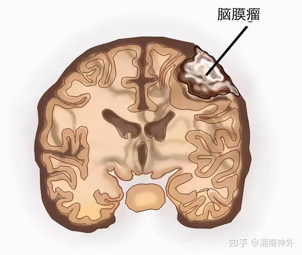 大脑镰旁脑膜瘤图片