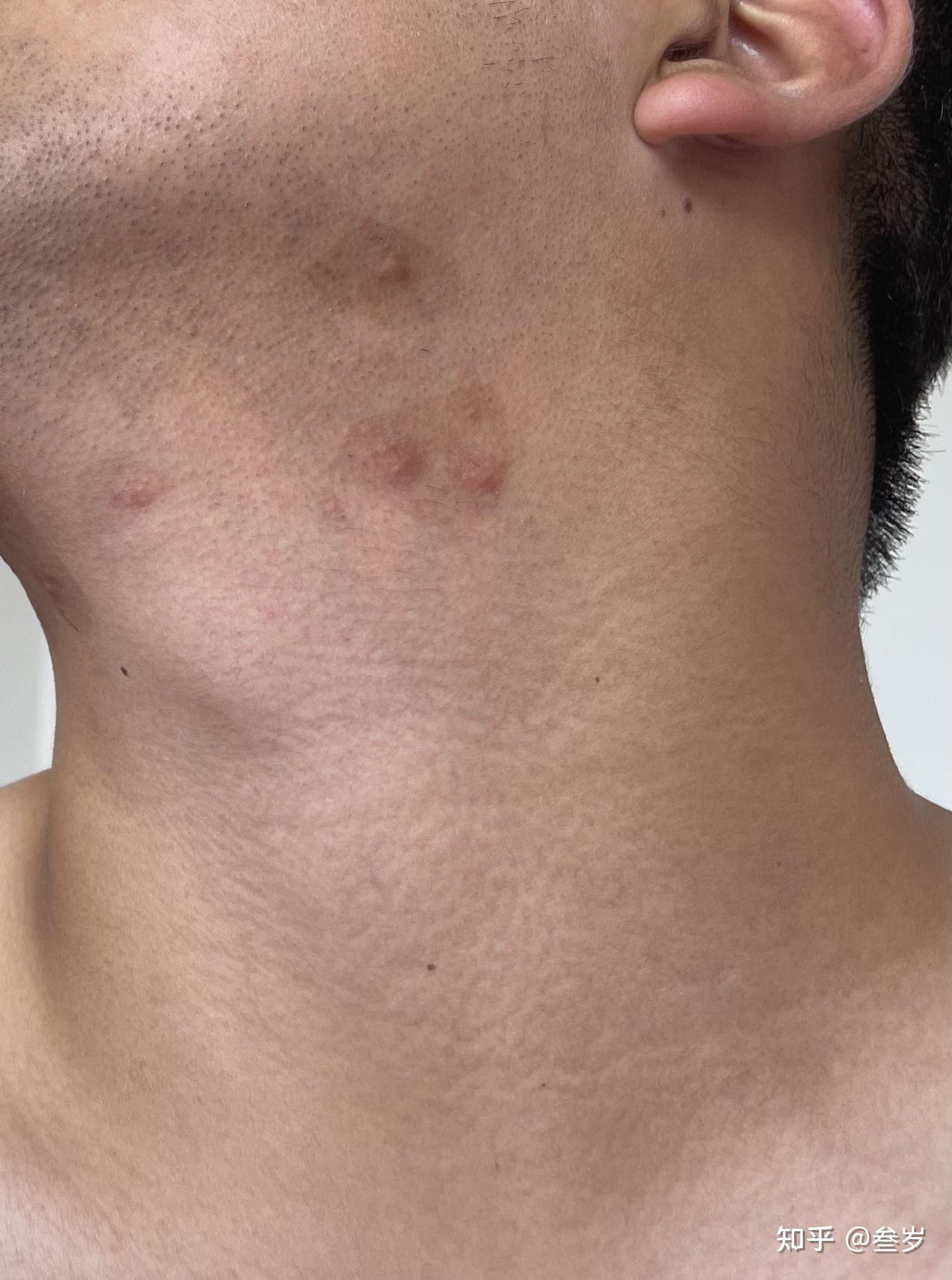 分享疤痕疙瘩的治疗过程