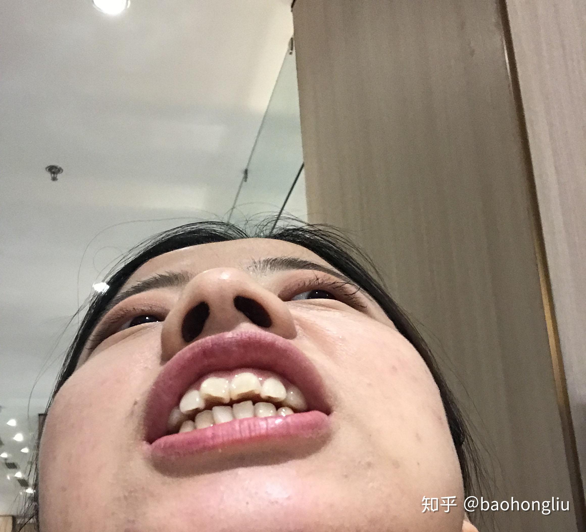 马上27岁的剩女阿姨的整牙日记