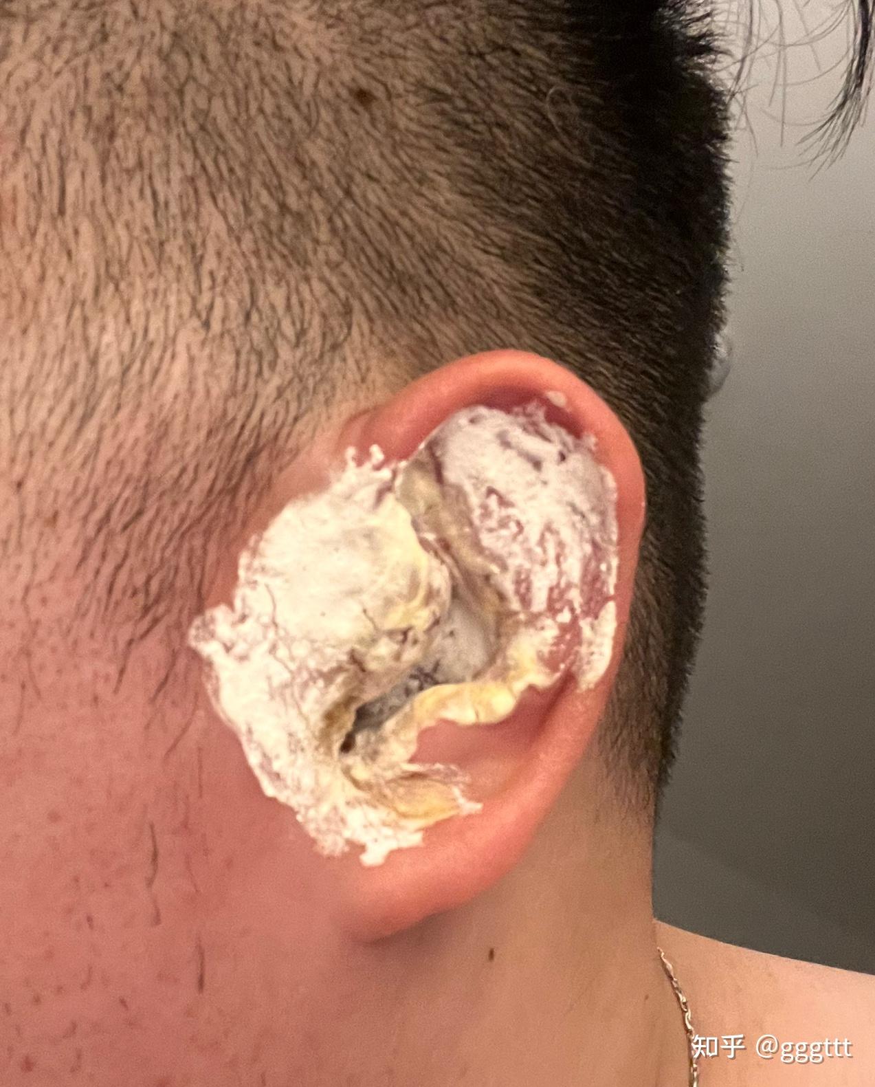 耳前瘘管发炎 