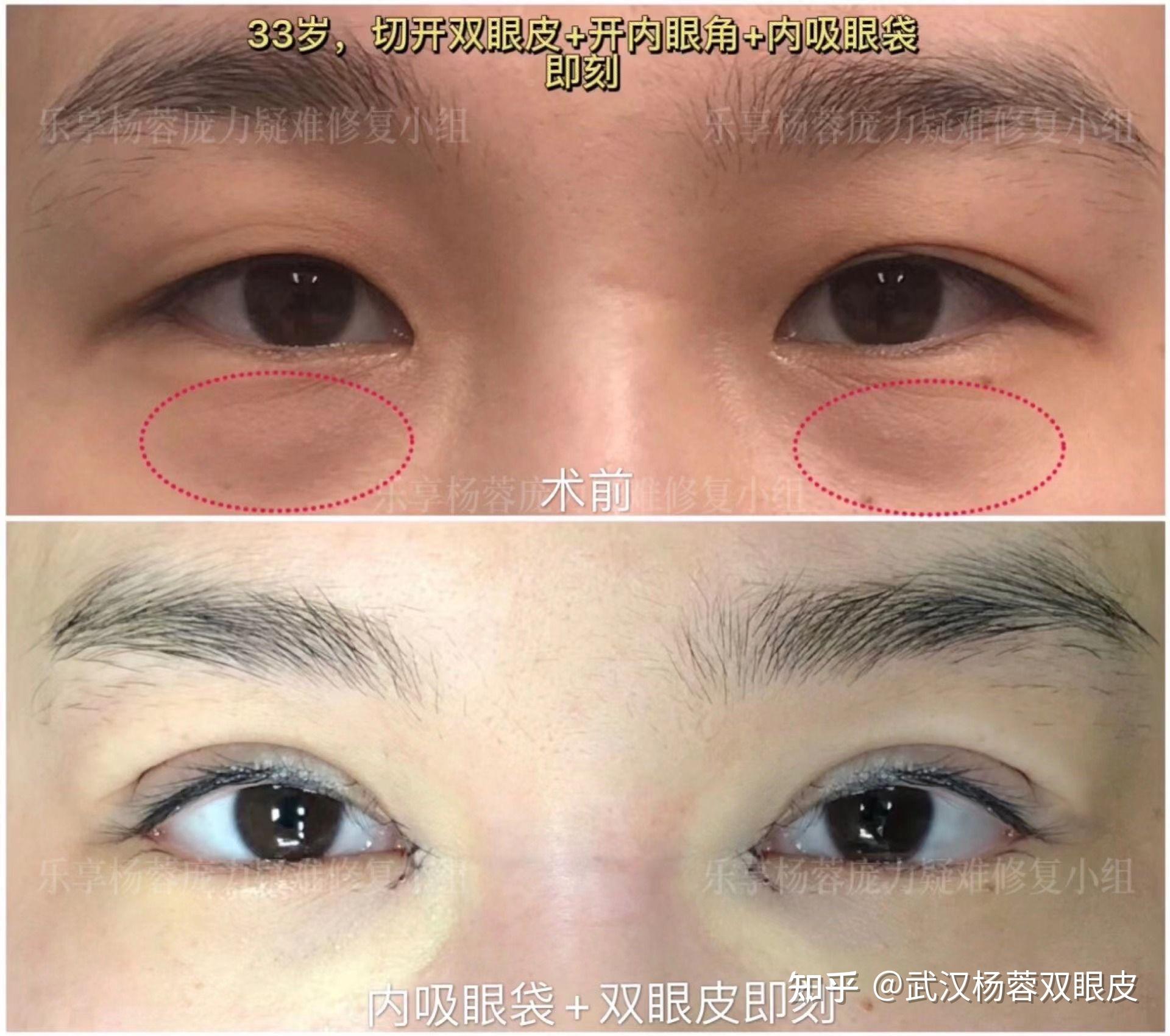 仿生态双眼皮开内眼角内吸眼袋