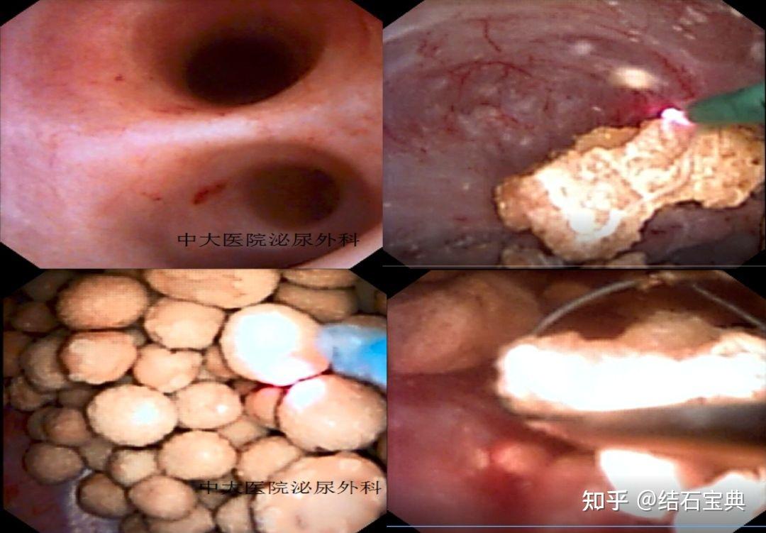 尿路結石的治療方法和治療原則