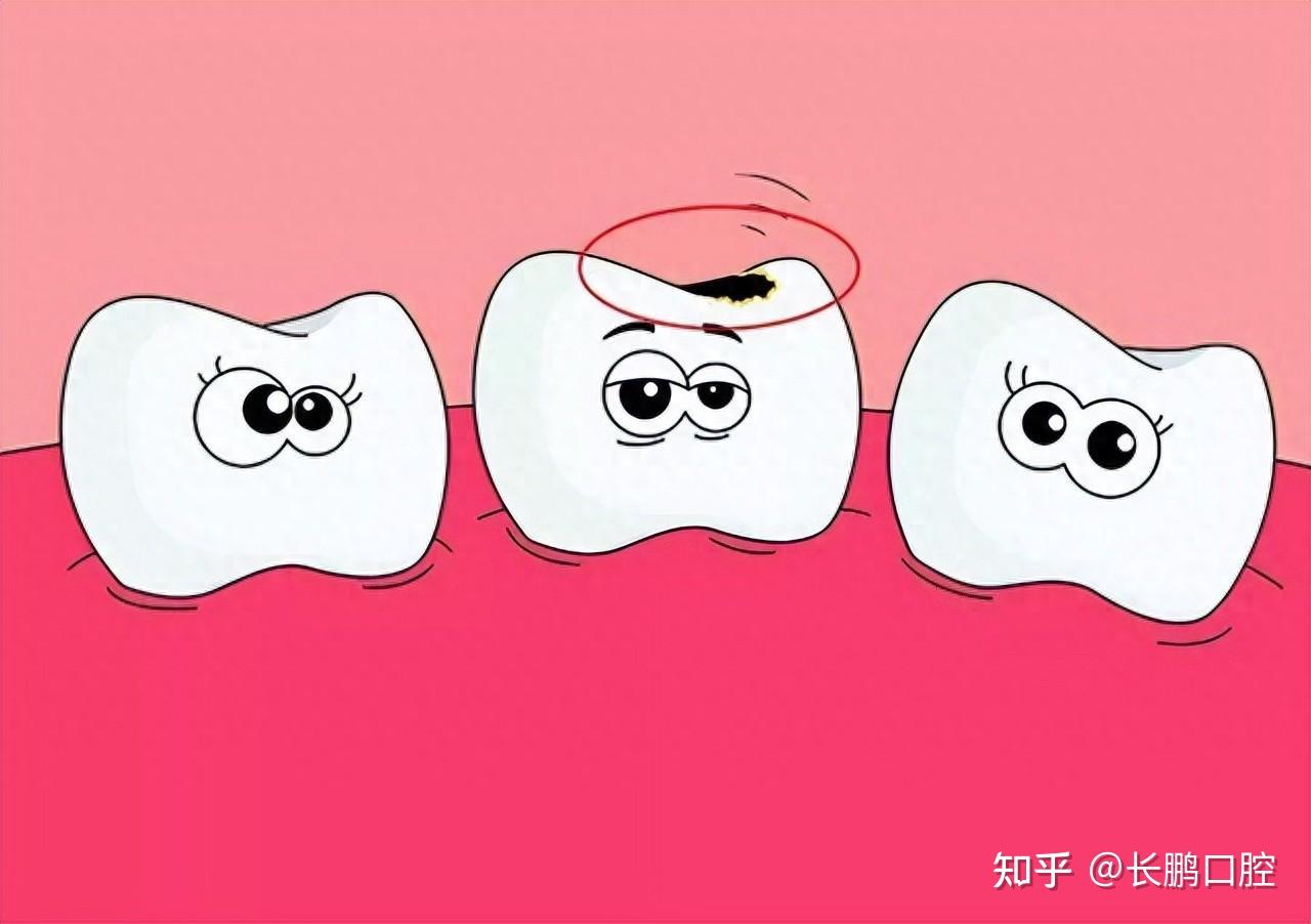 牙齒變黑了怎麼辦？part II：根管治療後，不只牙齒顏色變深，牙齦也黑黑的。 - 牙科美容資訊 - 美容牙科張凱榮醫師