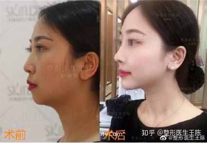 这种情况隆鼻千万别选耳软骨 知乎
