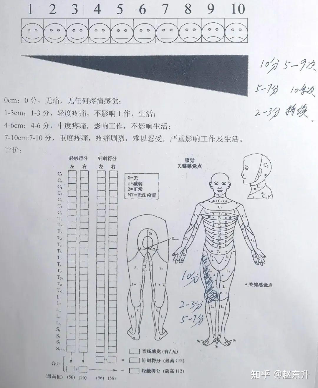 SCS脊髓电刺激疗法DTM™程控模式治疗25年右下肢顽固性疼痛 知乎