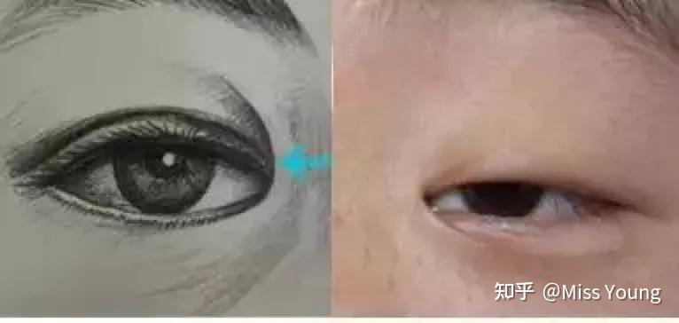这种类型的内眦赘皮一般不会随着年龄增长而消失.