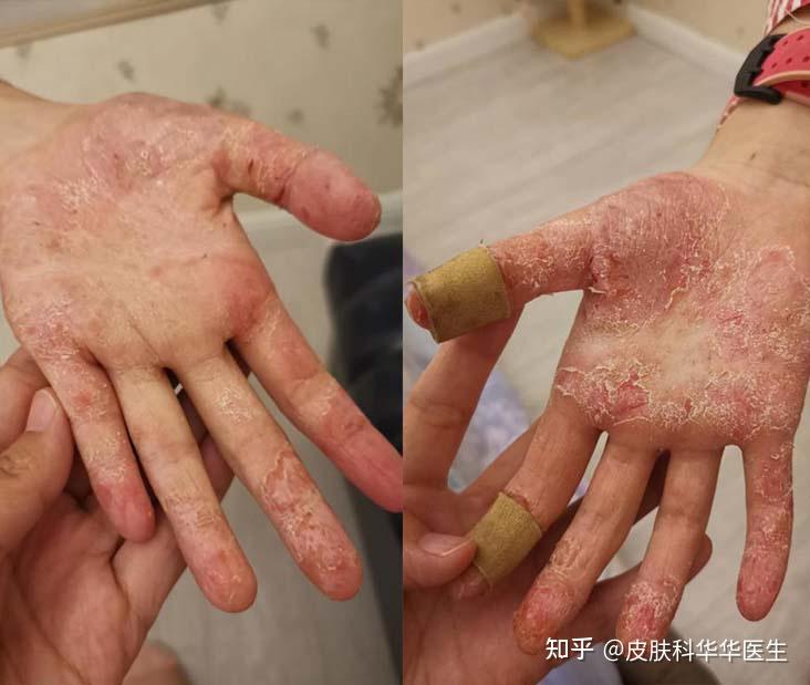 门诊案例湿疹小女孩双手皲裂调理脾胃后一个月就见效