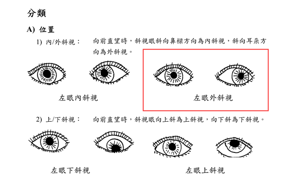 如何纠正斜视 成年内斜视怎么矫正 二安网