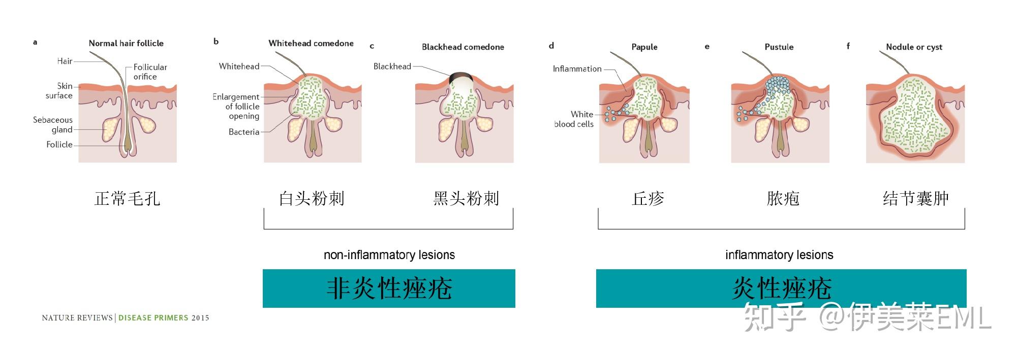 （痤疮周）关于痘痘-不得不知道的常识 - 知乎
