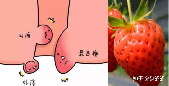 痔疮如何少受苦早康复免开刀