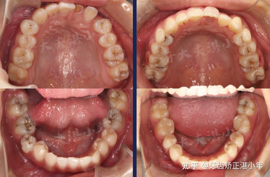 长沙牙齿矫正高难度案例埋伏牙咬合紊乱复杂治疗