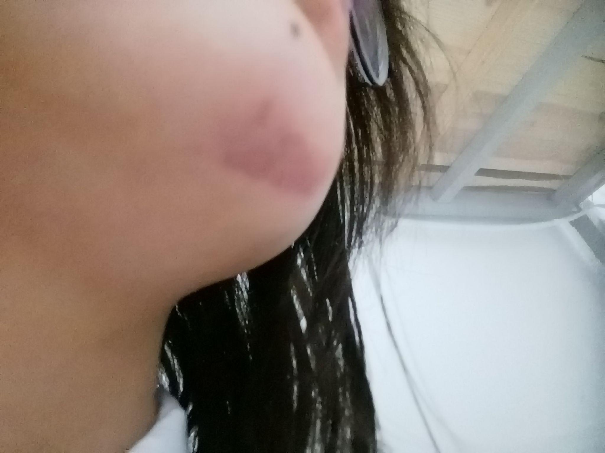 最近无缘无故突然发现下巴有一块类似淤青的东西室友突然看到的说像是