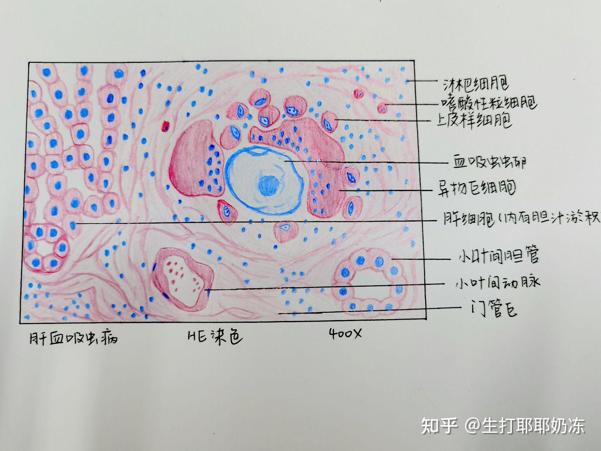 腺淋巴瘤画图图片