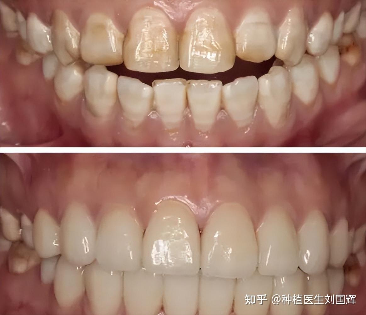 牙齿有这种黄色斑点,想要清理,只有这几种方法最有效