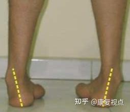 步态分析，详解人类步态和异常步态 - 知乎
