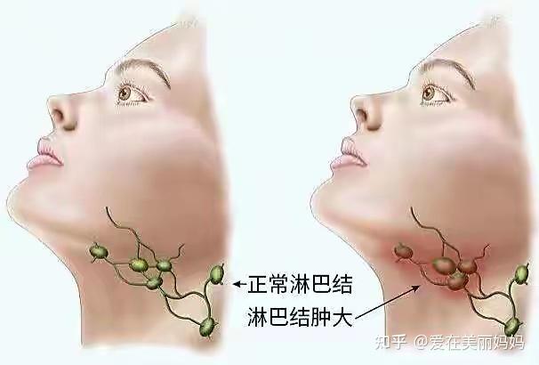 面部淋巴管分布图图片