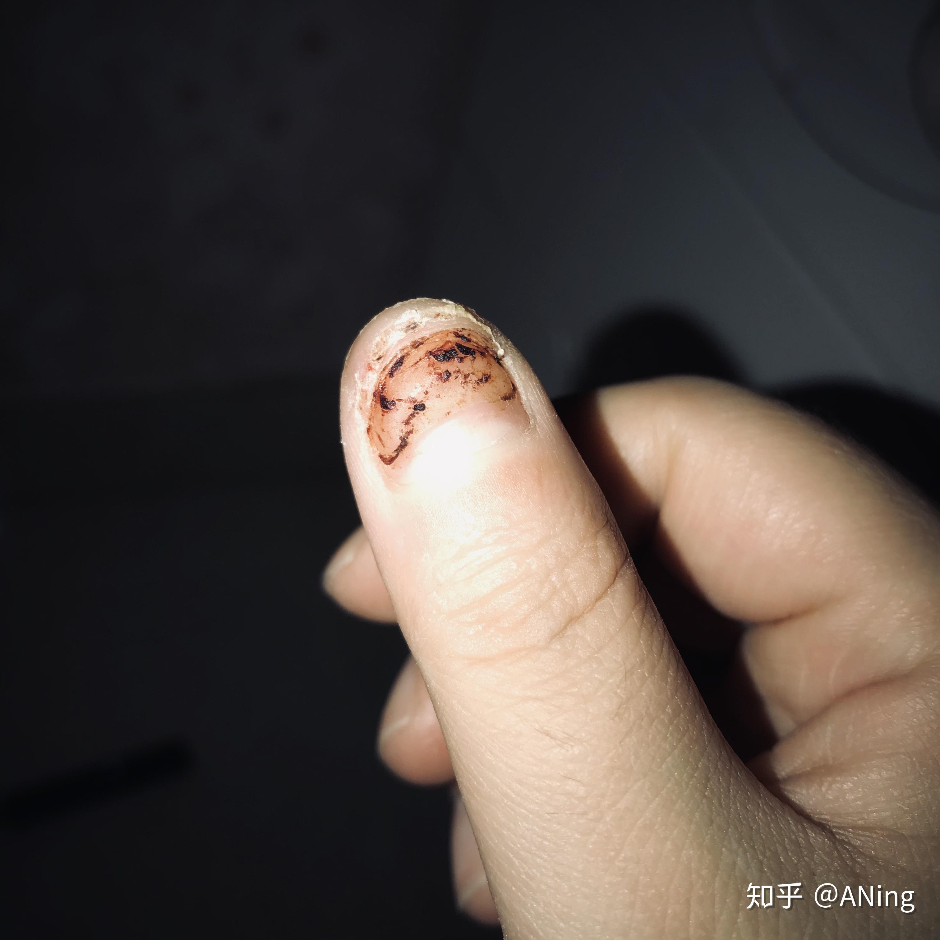手指甲被车门夹了