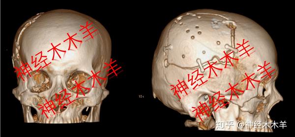 医生剜掉了我的头骨 之后怎么办呢 知乎