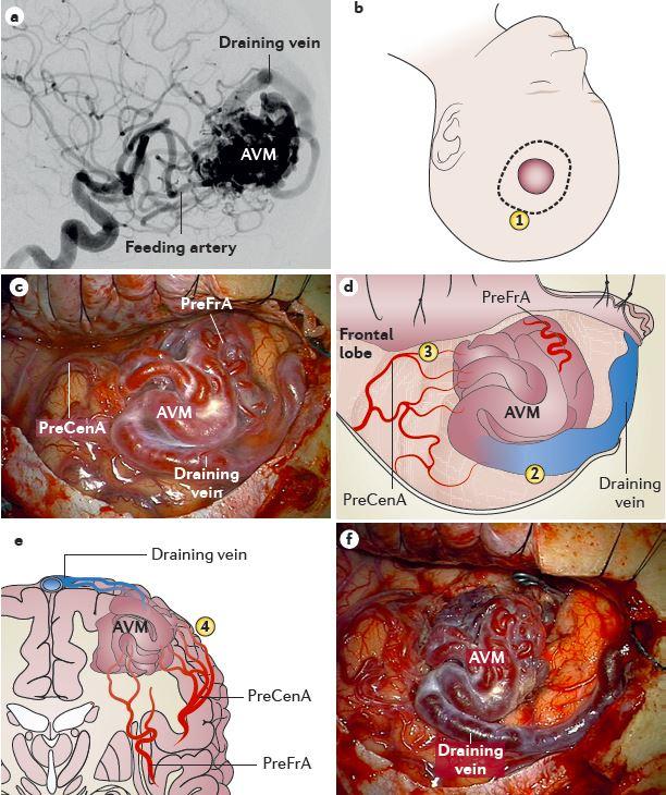剧集 Doctors 里的神经外科知识 五 脑血管畸形 Cerebral Arteriovenous Malformation Cavm 知乎